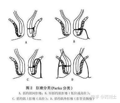 肛瘺的最新治療方法,肛瘺的最新治療方法