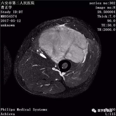 橫紋肌樣瘤最新治療技術(shù),橫紋肌樣瘤最新治療技術(shù)，突破與希望