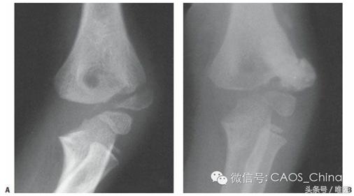 肘內(nèi)翻的最新矯正技術(shù),肘內(nèi)翻的最新矯正技術(shù)